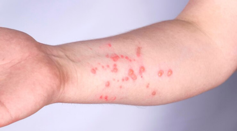 Casos de mpox avançam no Brasil: há motivos para preocupação?